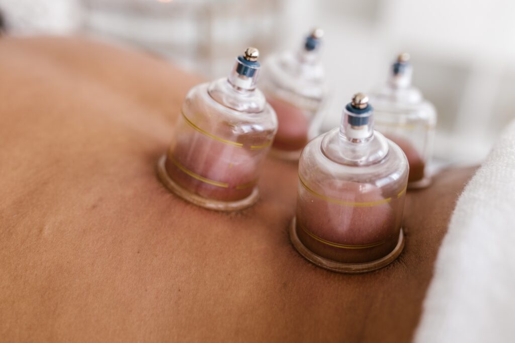 cupping therapy near me - Healthier Veterans Today