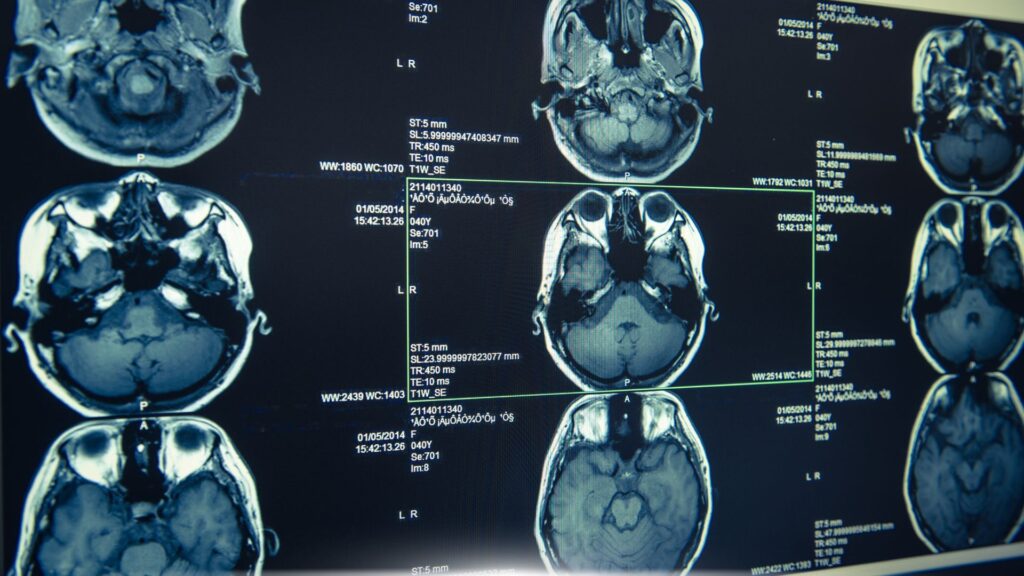 Brain injury shown on screening // Healthier Veterans Today